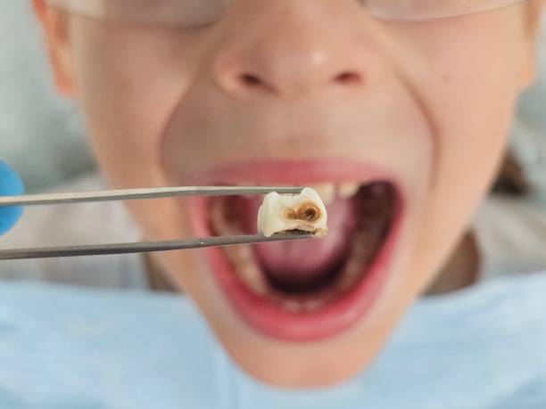 Best Emergency Treatment for Dental Infections or Abscesses in Bayport, NY